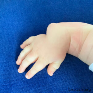 Right baby hand radial aplasia (few months of age) - dorsal view