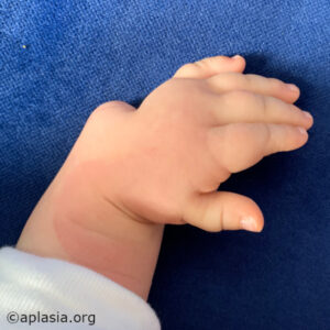 Left baby hand radial aplasia (few months of age) - dorsal view